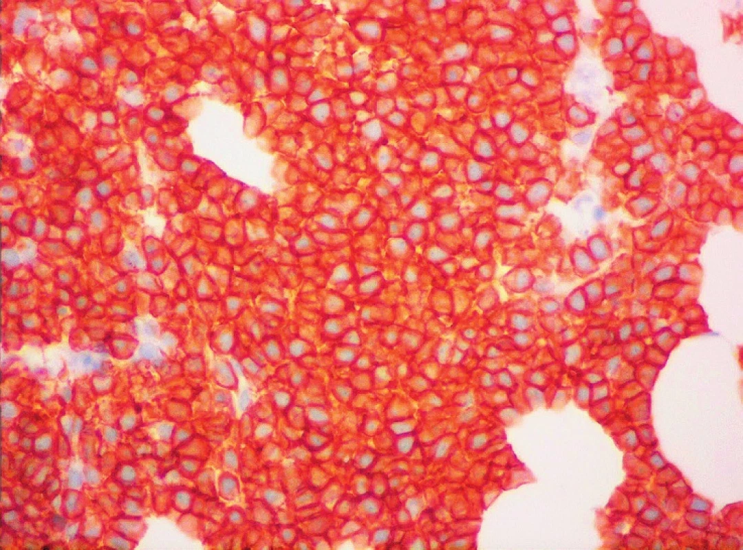 MCL, membránová pozitivita CD5, imunohistochemie, světelná mikroskopie, zvětšení 400krát
(Publikováno se souhlasem CGB laboratoře a. s.)
