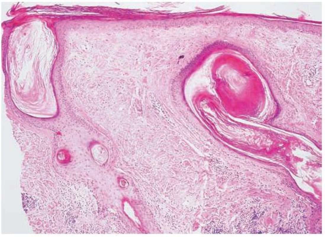Diskoidní lupus erythematodes (HE, původní zvětšení 100krát)
