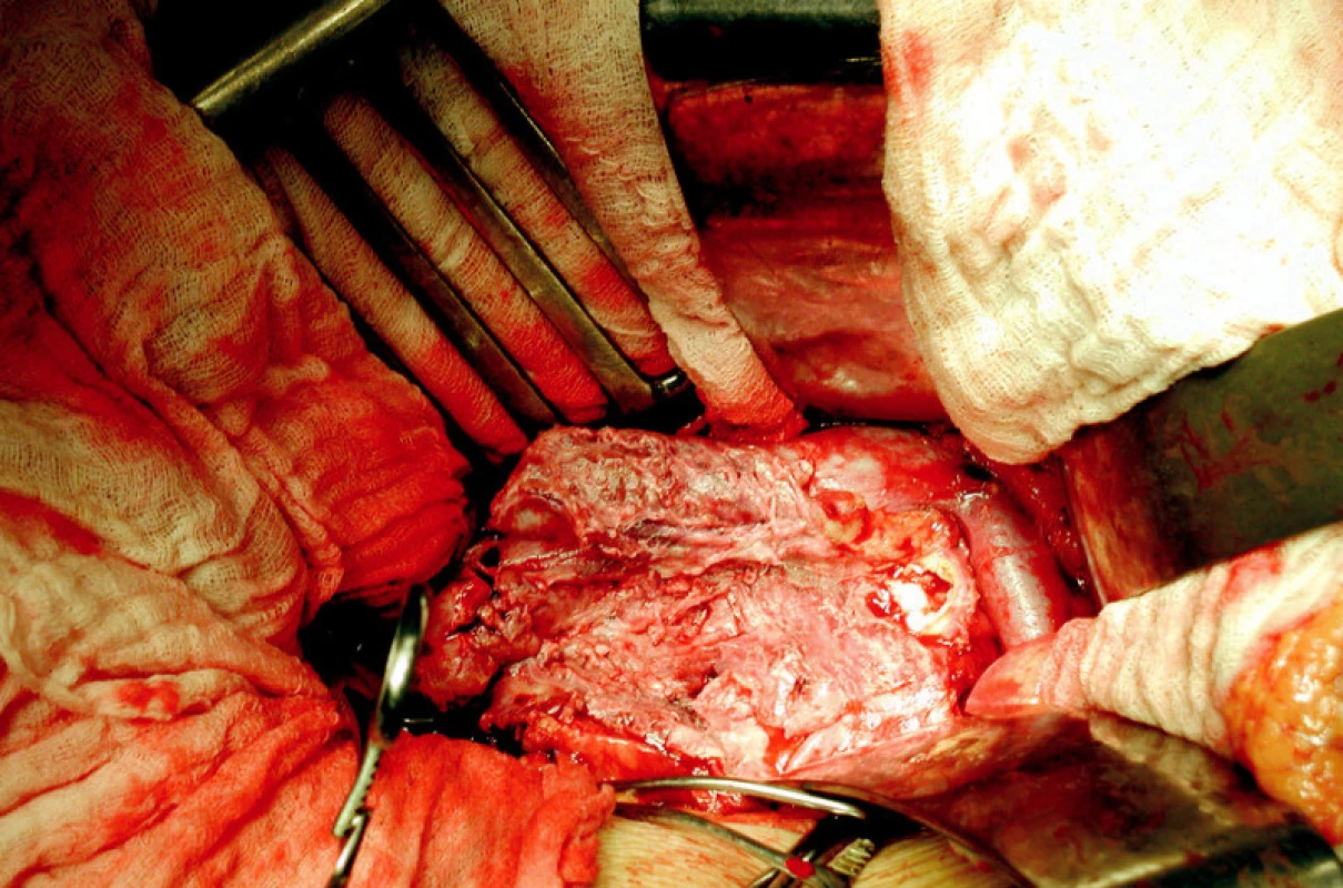 Resekce subrenálního mykotického aneuryzmatu abdominální aorty
Fig. 3. Resection of the mycotic aneurysm of the infrarenal abdominal aorta