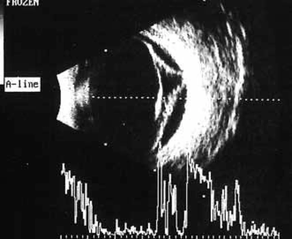 Pacient č. 2: Ultrasonografie oka pravého: hemoftalmus, hyperechogenní linie odpovídající trakčnímu odchlípení sítnice.