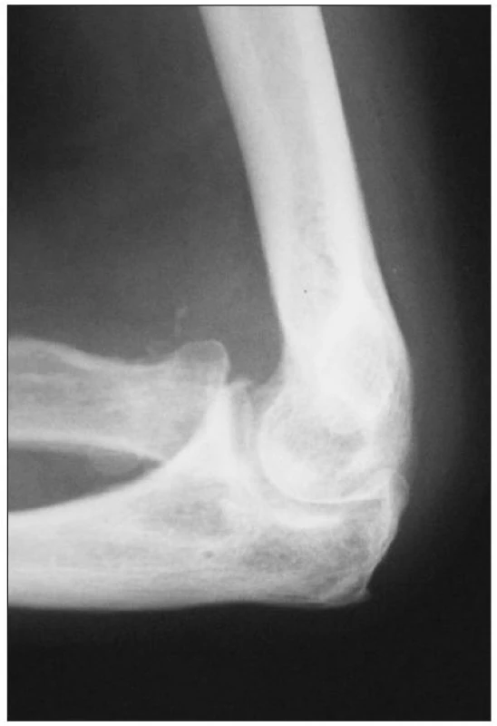 Bočná RTG snímka ľavého lakťa 4 mesiace po úraze, luxácia hlavičky radia pretrváva
Fig. 4. Lateral radiograph of the left elbow taken 4 months after injury, dislocation of the radial head persists