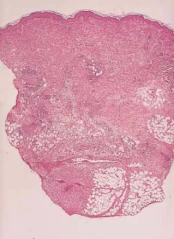 EN – histologický obraz – zesílená septa se zánětlivým infiltrátem (převzato z 6)