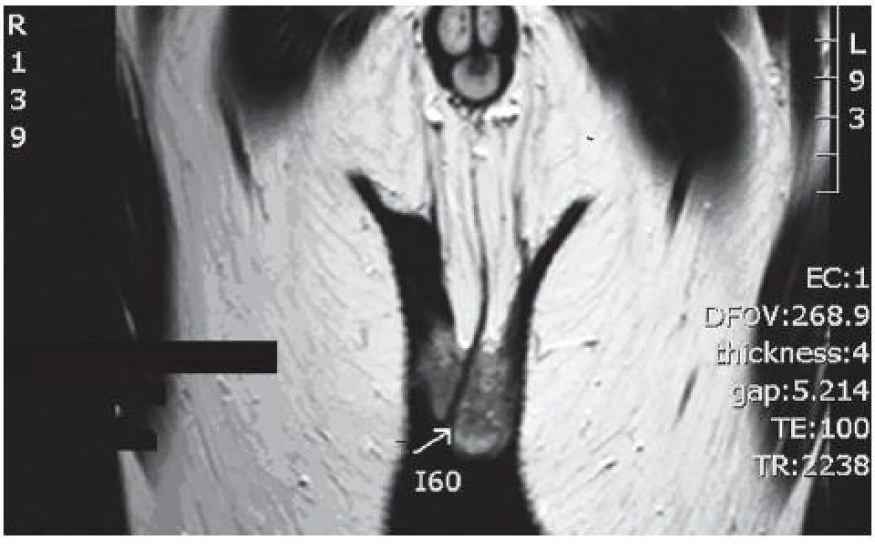 Hypoechogenní léze v levém varleti dle NMR
Fig. 1. NMR showing hypoechoic lesion in the left testicle according NMR