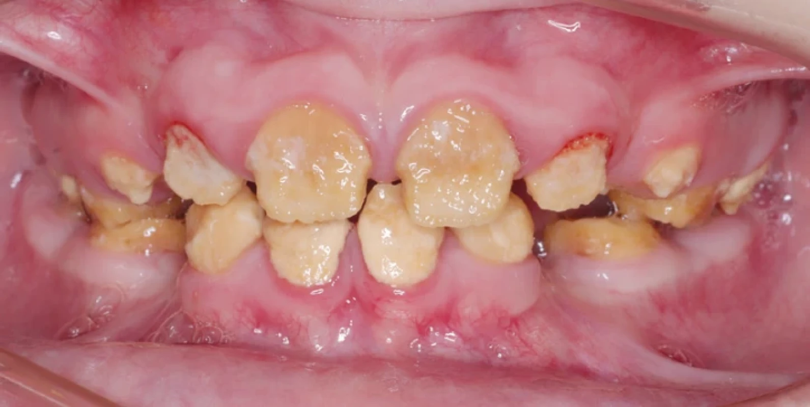 Intraorální fotografie pacienta s hypokalcifikační formou amelogenesis imperfecta. Měkká sklovina je přítomna zejména v krčkové oblasti, dále je patrná na hrotu prořezávajícího zubu 24. Rychlé odlučování skloviny vede k jantarovému zbarvení zubů. Archiv obrazové dokumentace Stomatologické kliniky FNKV, 3. LF UK a Rozštěpového centra FNKV Praha. Fig. 3 Intraoral image of a patient with the hypocalcification form of amelogenesis imperfecta. Soft enamel is present, particularly in the cervical regions, and is also visible on the cusp of the erupting tooth 24. The rapid loss of enamel results in amber discoloration of the teeth. Archive of Department of Stomatology, 3rd Faculty of Medicine, Charles University, and University Hospital Kralovske Vinohrady, and Cleft Centre Prague, University Hospital Kralovske Vinohrady.