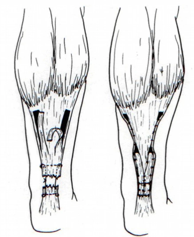 Plastika dle Lindholma [5] 
(Volně podle Lindholm, A.: A new method of operation in subcutaneous rupture of the Achilles tendon. Acta Chir Scand. 117, 261–270, 1959. )
