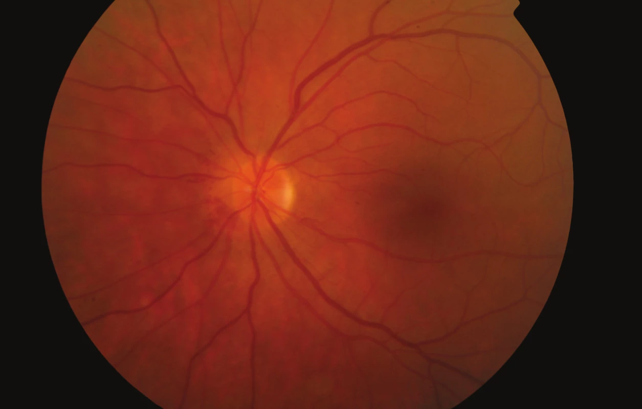 Fundus levého oka měsíc po vzniku pretrombotického stavu