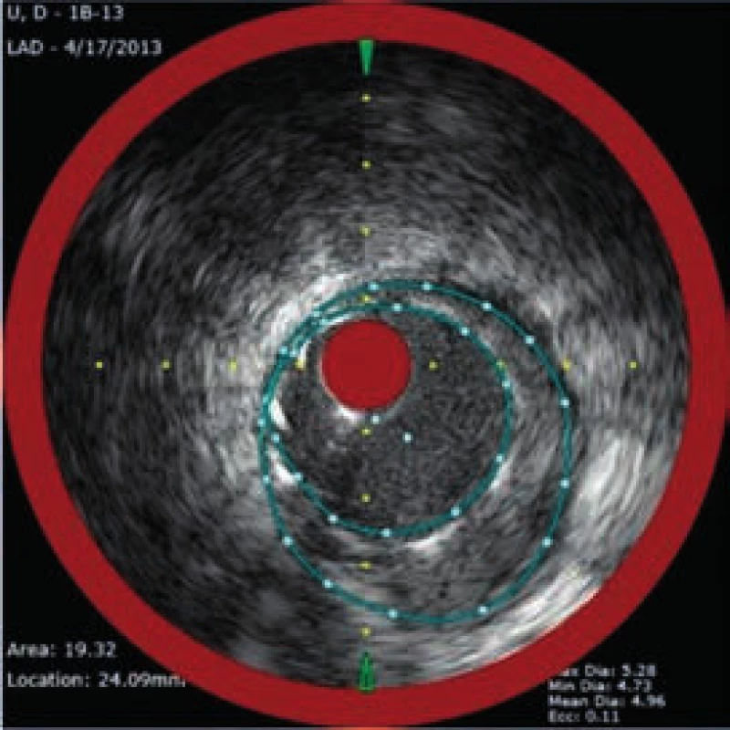 NIRS + IVUS po implantaci lékového stentu