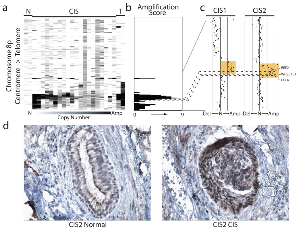 Amplification and overexpression of BRF2 in preinvasive SqCC lesions.