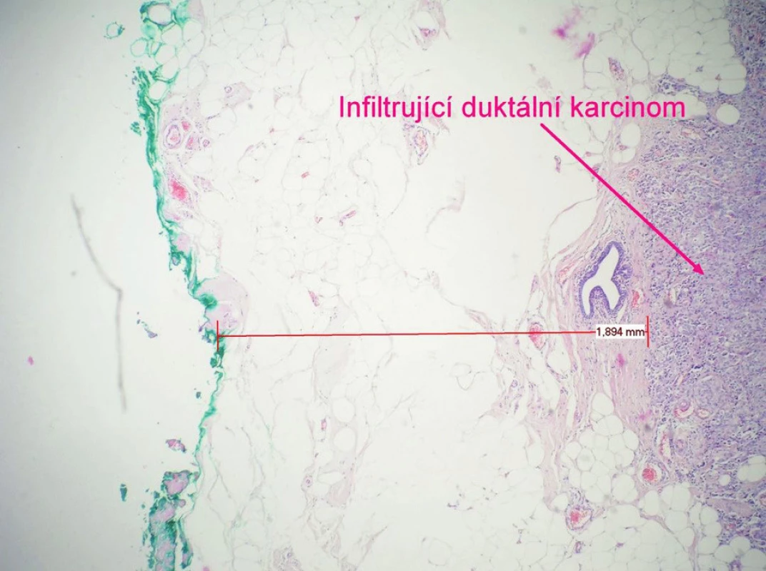 Resekční okraj
Pic. 3. Resection margin