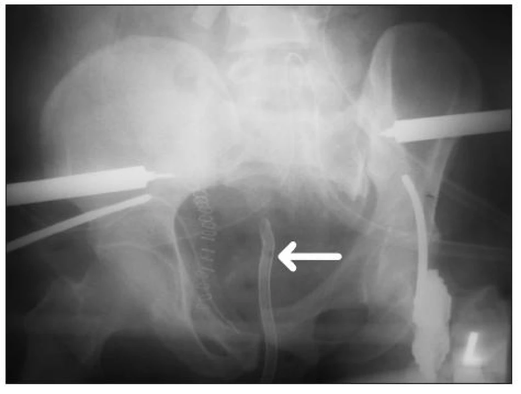 RTG snímek pánve po primární stabilizaci zlomeniny zevní fixací a pánevní svorkou. RTG kontrastní Dufourův močový katétr označen šipkou
Fig. 1. X-ray picture of the pelvis after primary stabilisation by external fixator and pelvic C-clamp. Dufour catheter visible in X-ray picture is marked with arrow