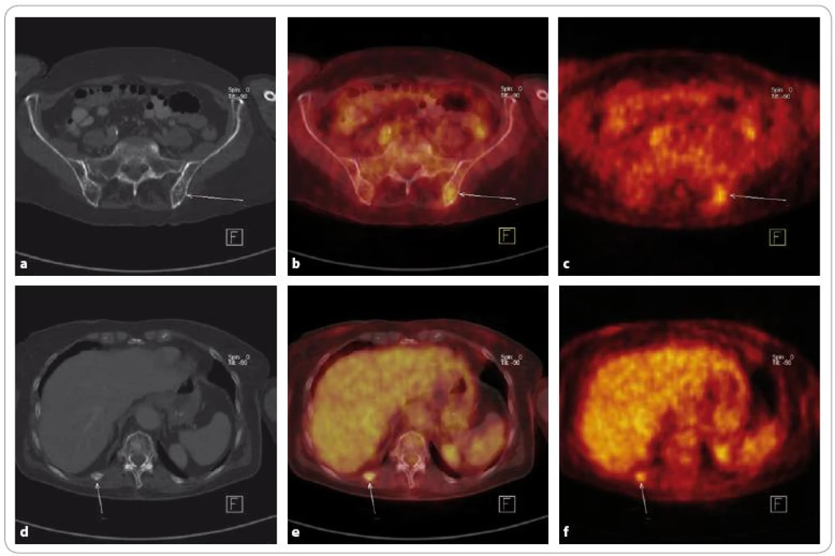 Mnohočetný myelom ve stadiu III, suspektní relaps – stejný pacient jako na obr. 2. Při <sup>18</sup>F-FDG PET/CT je patrné ložisko zvýšené konzumpce glukózy v lopatě levé kosti kyčelní, na CT osteoporóza. Další ložisko je lokalizováno v 11. žebru paravertebrálně vpravo, kde je na CT fraktura. Zvýšená akumulace FDG ve frakturách bývá obvyklým nálezem, a nádorovou tkáň zde tedy nelze vyloučit ani potvrdit. Nález v levé kyčelní kosti však byl hodnocen jako ložisko viabilní nádorové tkáně a byla zahájena chemoterapie.