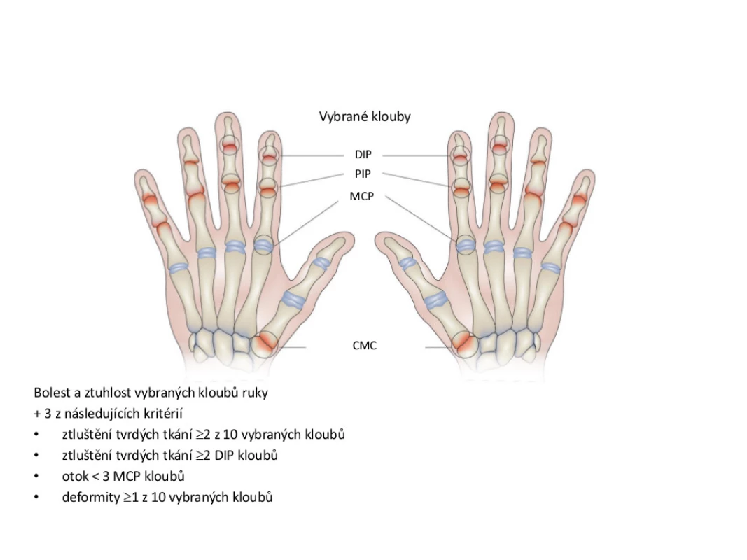 Klasifikační kritéria osteoartrózy (OA) rukou podle Americké revmatologické asociace <em>(upraveno dle: Altman et al., 1990)</em>