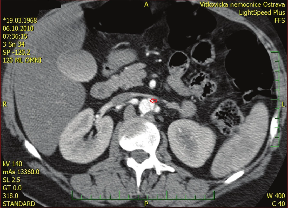 Obraz disekce subrenální aorty
Fig. 2: Picture showing infrarenal aortic dissection