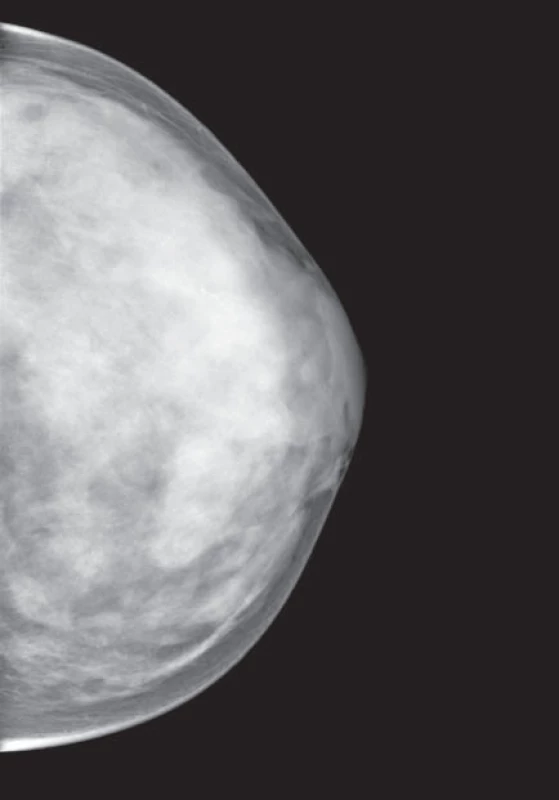 Mamogram – vysoce denzní žláza Tabár V (dense breast)