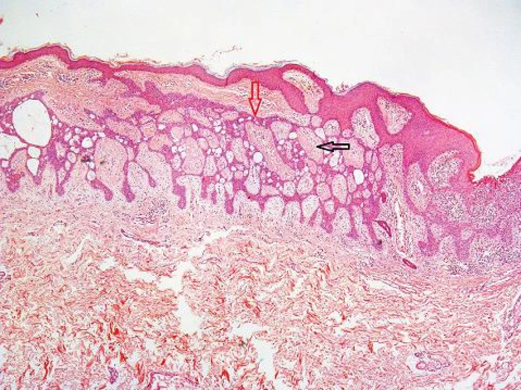 Fibroepitelióm (HE 25x)
