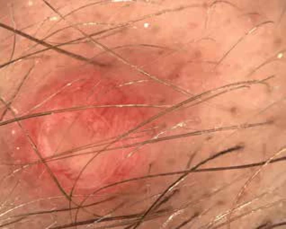 Dermatoskopický obraz nádoru s přítomností zesílených, větvících se cév, bez přítomnosti pigmentace