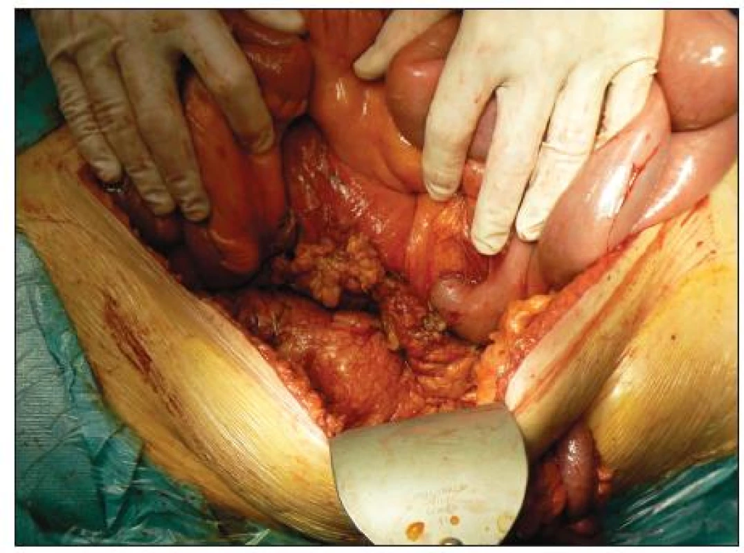 Stav po prekrytí retroperitonea omentálnym lalokom
Fig. 4. Status post omentoplasty of the retroperitoneum