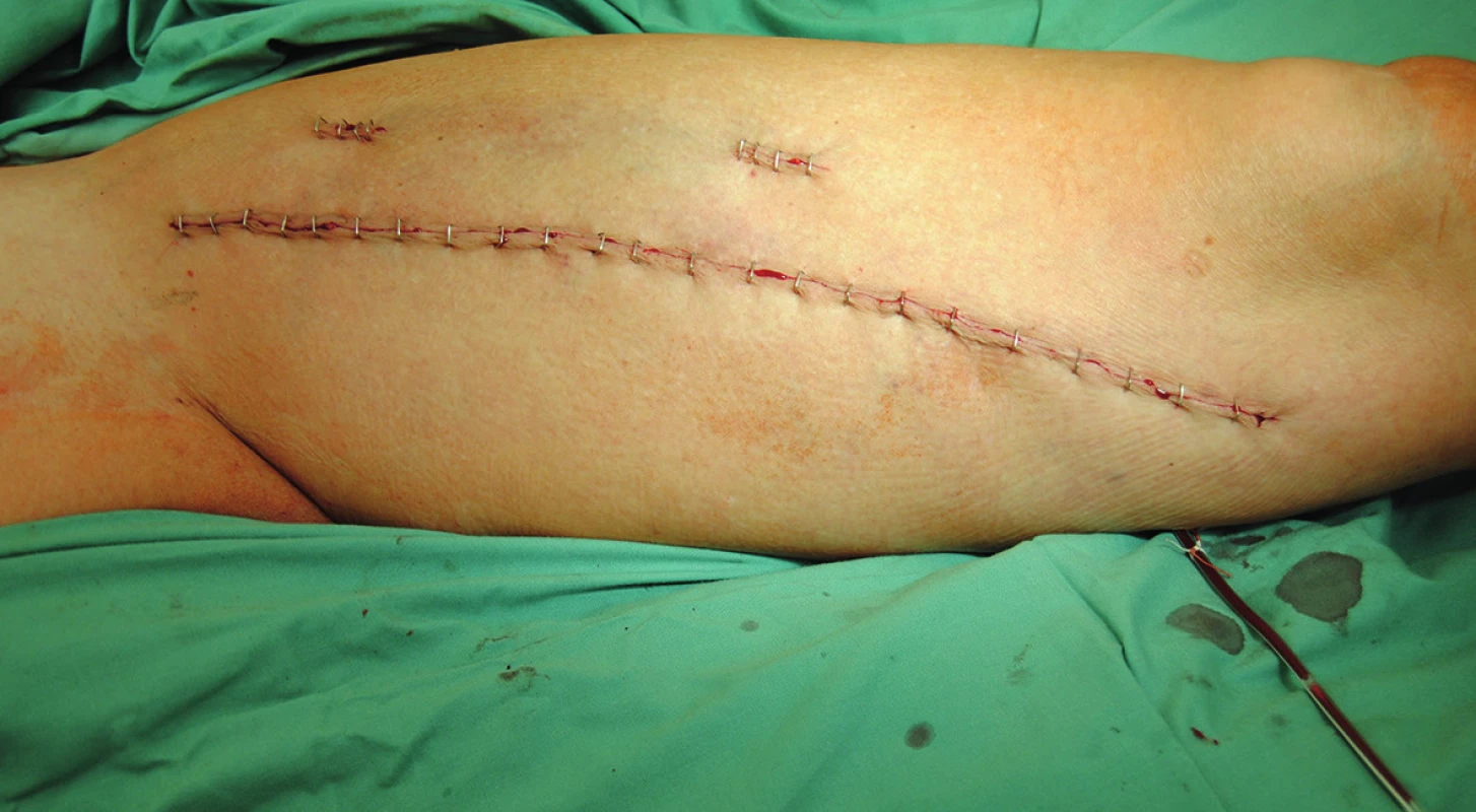 Viditelný úsek VFS graftu vhodný ke kanylaci - mezi dvěma pomocnými incizemi
Fig. 3: Visible section of SFV graft for cannulation - between two auxiliary incisions