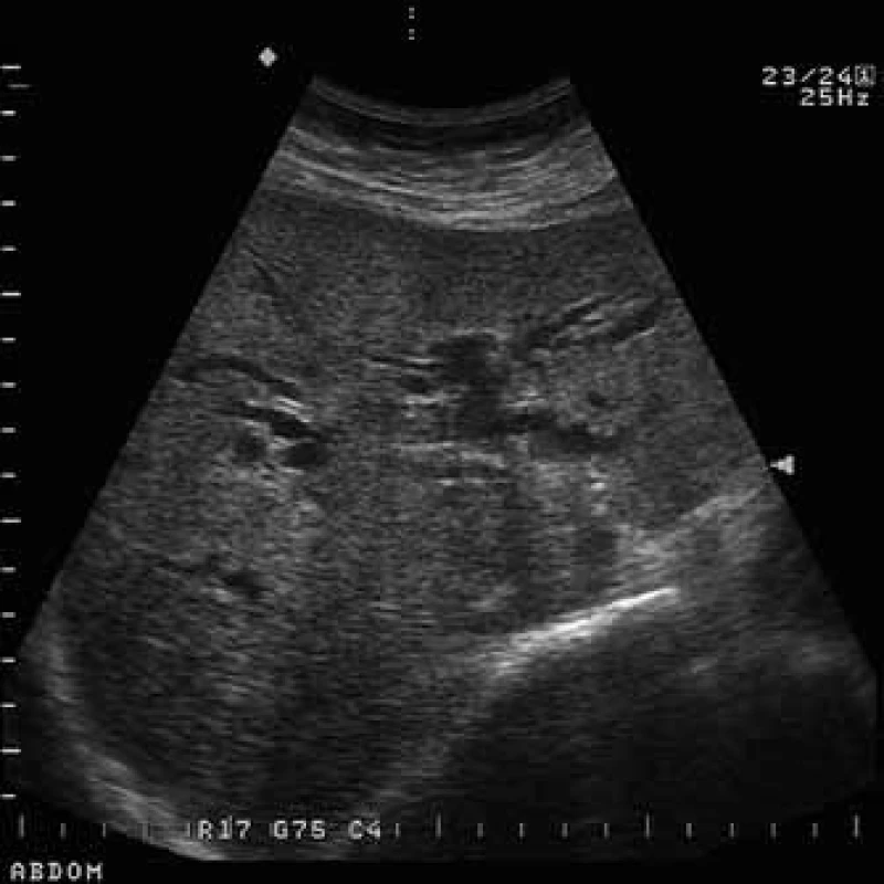 USG břicha: dilatace intrahepatálních žlučovodů.
Fig. 1. USG of abdomen: dilatation of the intrahepatic bile ducts.