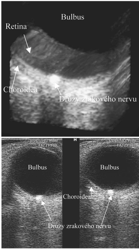 a. 2D USG drúzovitej formácie v hlave zrakového nervu
b. 3D USG drúzovitej formácie v hlave zrakového nervu
