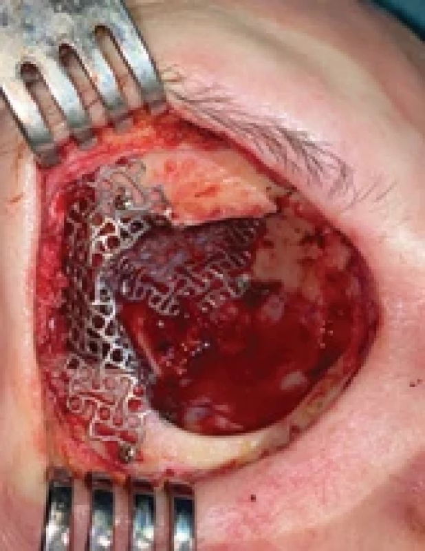 Reconstruction of the roof and lateral wall of the orbit with a titanium mesh after orbital exenteration and resection of the roof for adenoid cystic of the lacrimal gland.