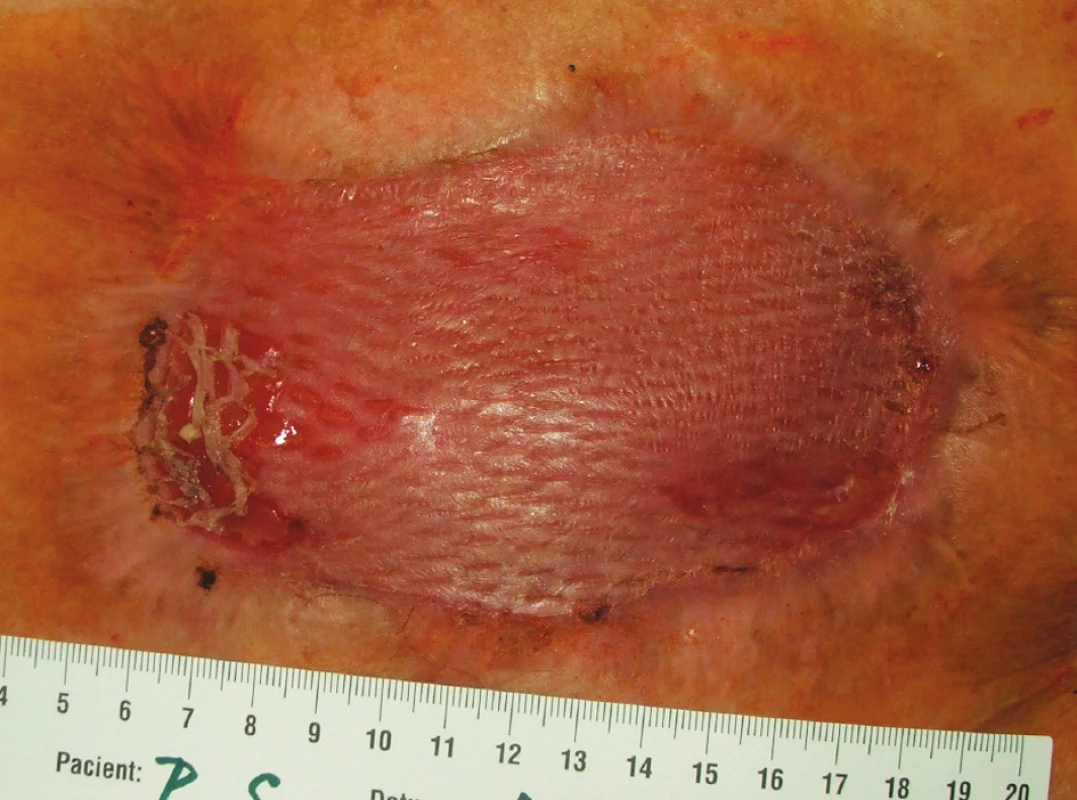 Situace 6 týdnů po rekonstrukční operaci GIT s ponechaným laparostomatem, stav po transplantaci kožního štěpu (pacient č. 9)
Fig. 6 The same patient 6 weeks after his GIT reconstruction procedure with laparostomy, following skin grafting (patient No 9)