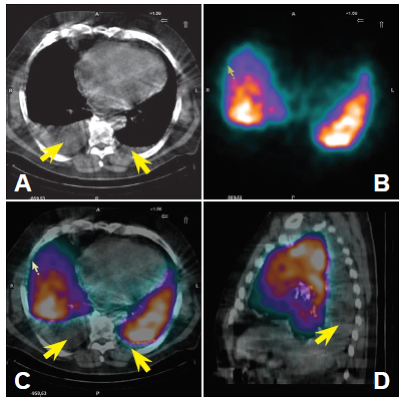 <i>SPECT/CT obraz: </i>