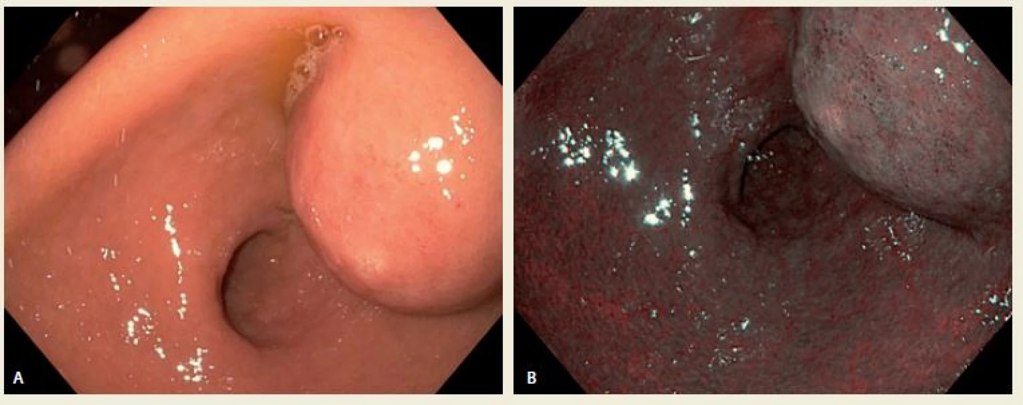 A,B. Gastroskopický obraz a – v normálním světle a b – pod NBI (Narrow Band Imaging).<br>
Fig. A,B. Antral intramural tumor in normal and NBI (Narrow Band Imaging).