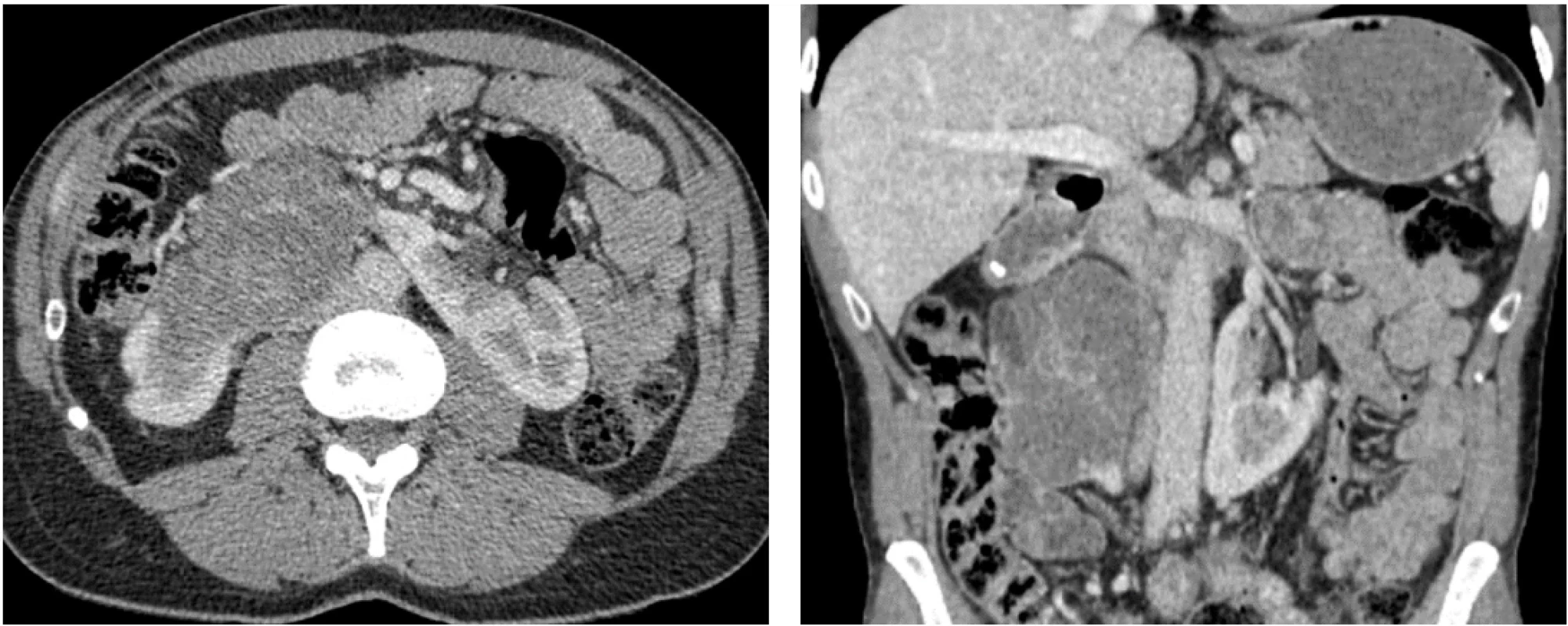 CT břicha s kontrastní látkou za 6 měsíců od zahájení léčby v transverzální a koronární projekci, velikost tumoru 90 × 50 × 95 mm. Fig. 3. A 6-month follow-up contrast-enhanced abdominal CT in transverse and coronal planes, tumor size 90 × 50 × 95 mm. 