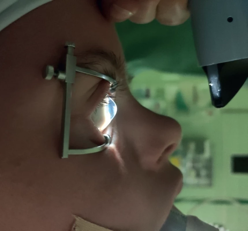 Corneal bulging in keratoconus in a patient with Down syndrome