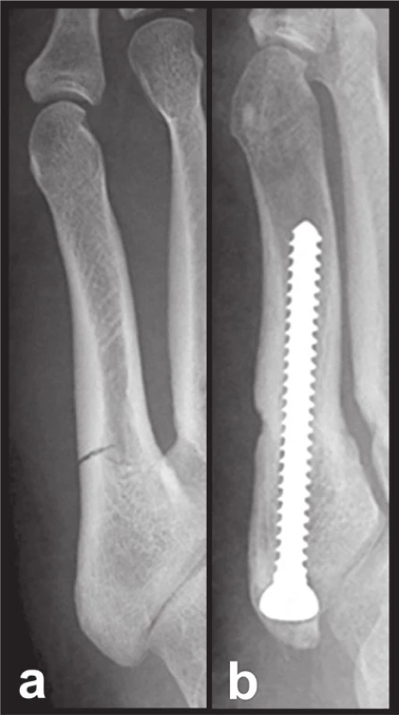 Osteosyntéza intramedulárním šroubem
Fig. 7: Internal fixation by intramedullary screw