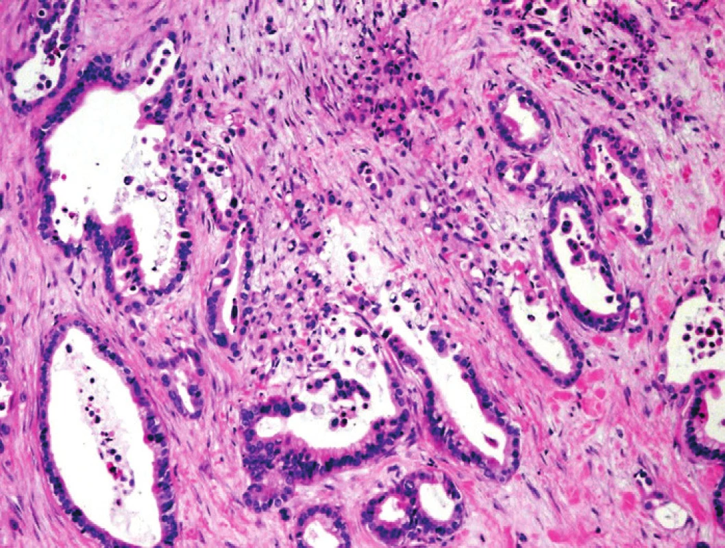 Pankreatický duktální adenokarcinom (PDA). Infiltrující nepravidelné neoplastické duktální struktury PDA, fokálně s vyjádřenými „rupturami duktů“, s asociovanými makrofágy a detritem intraluminálně. Barveno hematoxylinem eozinem (zvětšení 100x).
