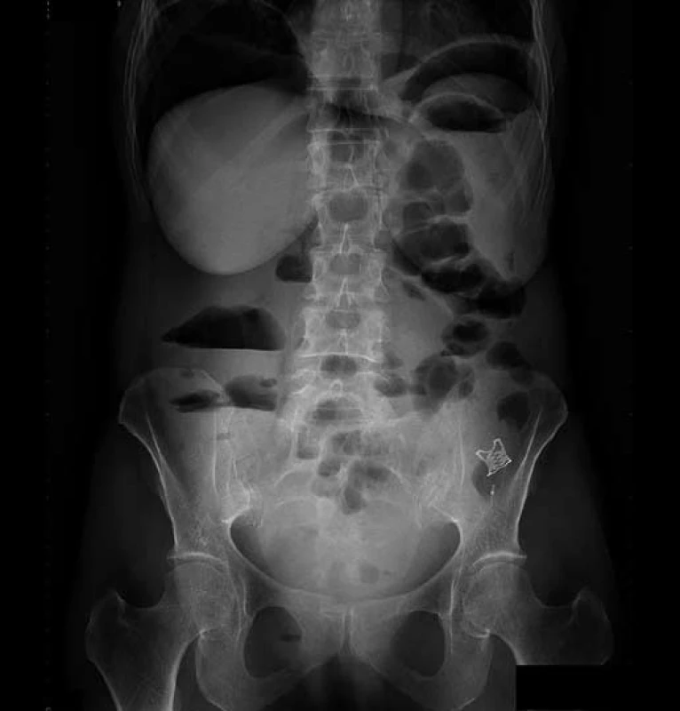 RT G nativ břicha 7. den po perforaci, přetrvávající pneumoperitoneum, OT SC<sup>®</sup> klip v levé dolní polovině břicha.
Fig. 5. Abdominal X-ray, day 7 after perforation, persistent pneumoperitoneum, OTSC<sup>®</sup> seen in the lower left abdomen.