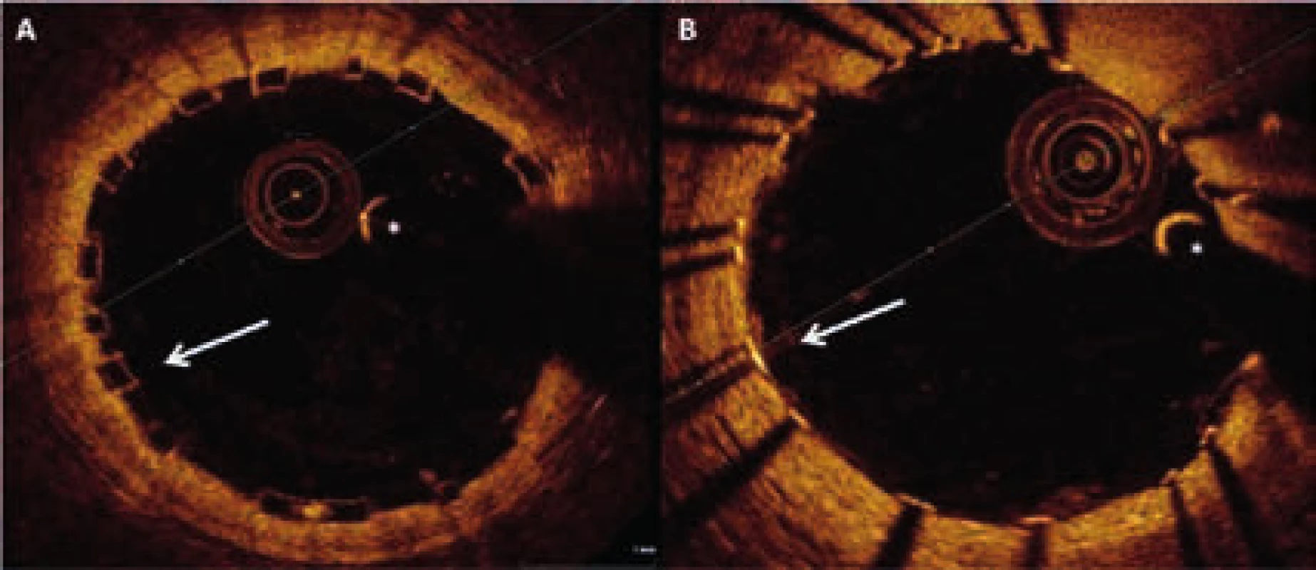 Intrakoronární zobrazení stentu pomocí optické koherenční tomografie