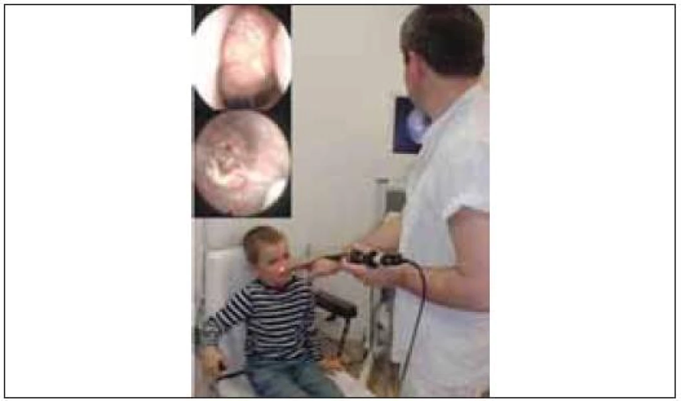 Flexibilní endoskopie na ORL ambulanci u dětského pacienta. V průběhu krátké diagnostické endoskopie tenkým fibroskopem s napojením na videořetězec (vyšetření trvá několik sekund v rukou erudovaného lékaře, většinou bez nutnosti lokální anestezie) je možné vyšetřit nosní dutiny, nosohltan (adenoidní vegetace 2-3. st. pohledem přes levou nosní dutinu) i hrtan.