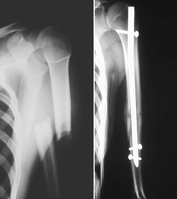 a. RTG obraz zlomeniny diafýzy pažní kosti
Pic. 3a. X-ray picture of the humeral shaft fracture
b. RTG obraz zhojené zlomeniny pažní kosti po nitrodřeňové osteosyntéze antegrádně zavedeným zajištěným hřebem UHN
Obr. 3b. X-ray picture of the healed humeral shaft fractures after intramedullar osteosynthesis by antegrade unreamed humeral nail