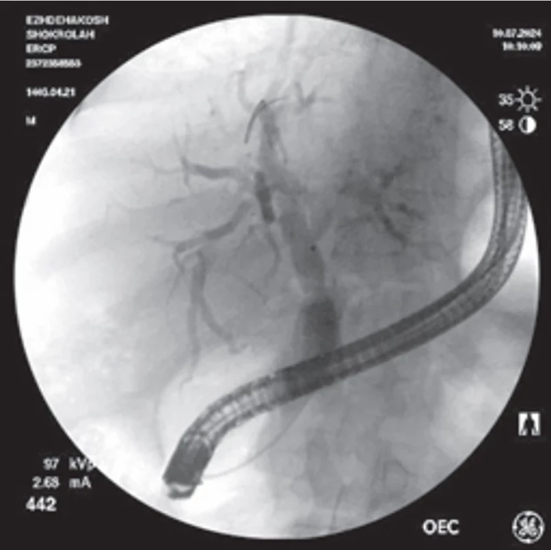 Fluoroscopic image of proximal common hepatic duct  (CHD) stricture in a 62-year-old male patient with PSC and  suspected cholangiocarcinoma (patient 2). Dilation was perfor med using a 4-mm coronary balloon, facilitating cytology bru shing and nasobiliary drainage. Obr. 2.  Fluoroskopický obraz striktury proximálního společného jaterního vývodu (CHD) u 62letého muže s PSC a podezřením na cholangio karcinom (pacient 2). Dilatace byla provedena pomocí 4mm koronárního balónku, což usnadnilo cytologické vyčištění a nazobiliární drenáž.