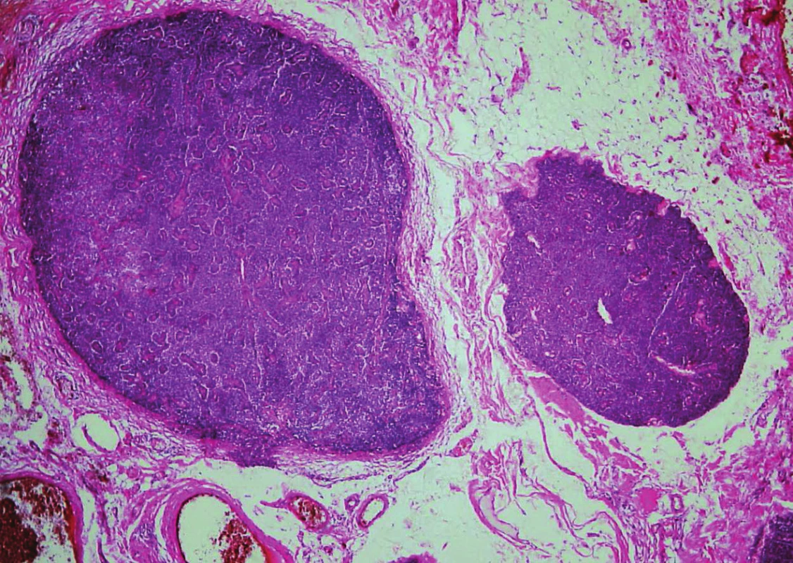 Parathyromatosis. In low magnifications, nodules of hyperplastic parathyroid tissue with smooth margins in cervical soft tissue (hematoxylin and eosin, magnifications x 40).