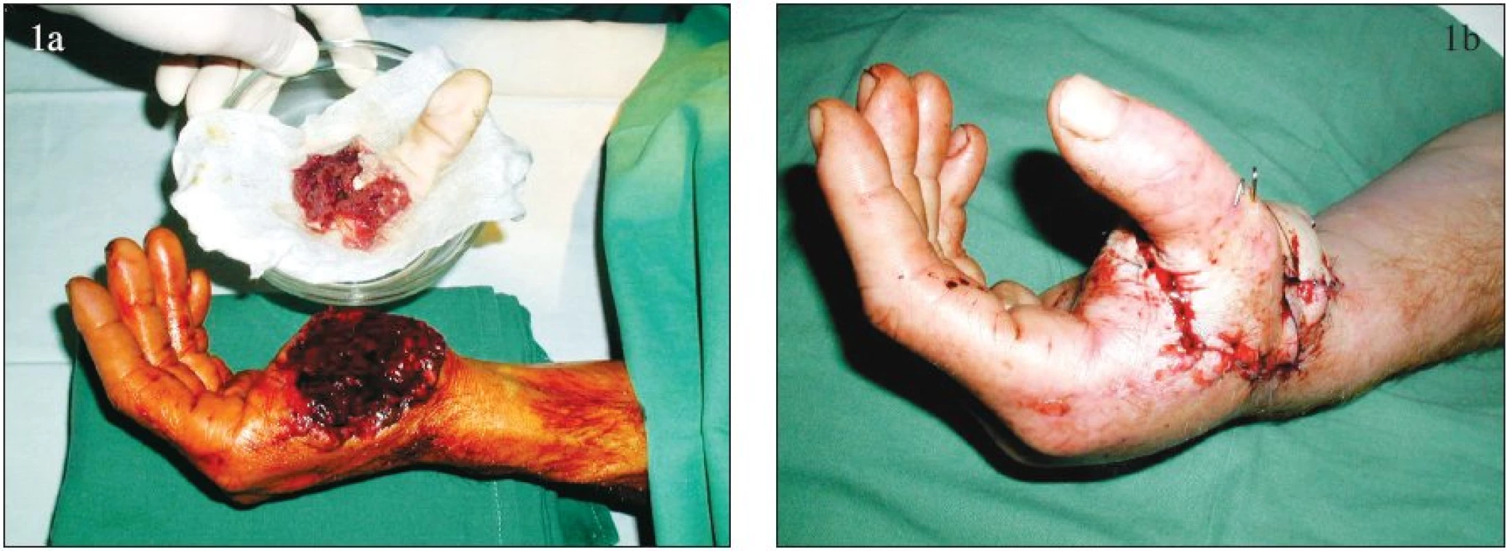 Replantace palce ruky: a – amputovaný palec, b – stav po replantaci.
Fig. 1. Thumb replantation: a – amputated thumb, b – post- replantation condition.
