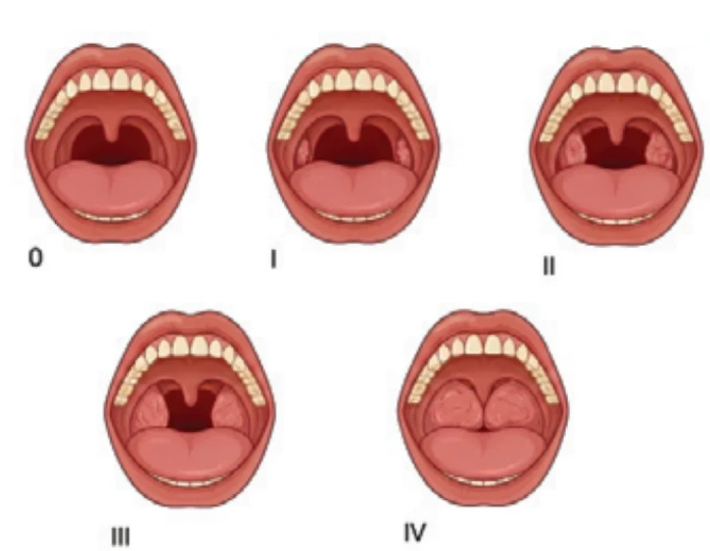 Friedmannova klasifi kace velikosti tonzil. Fig. 1. Friedman classifi cation of tonsil size. 