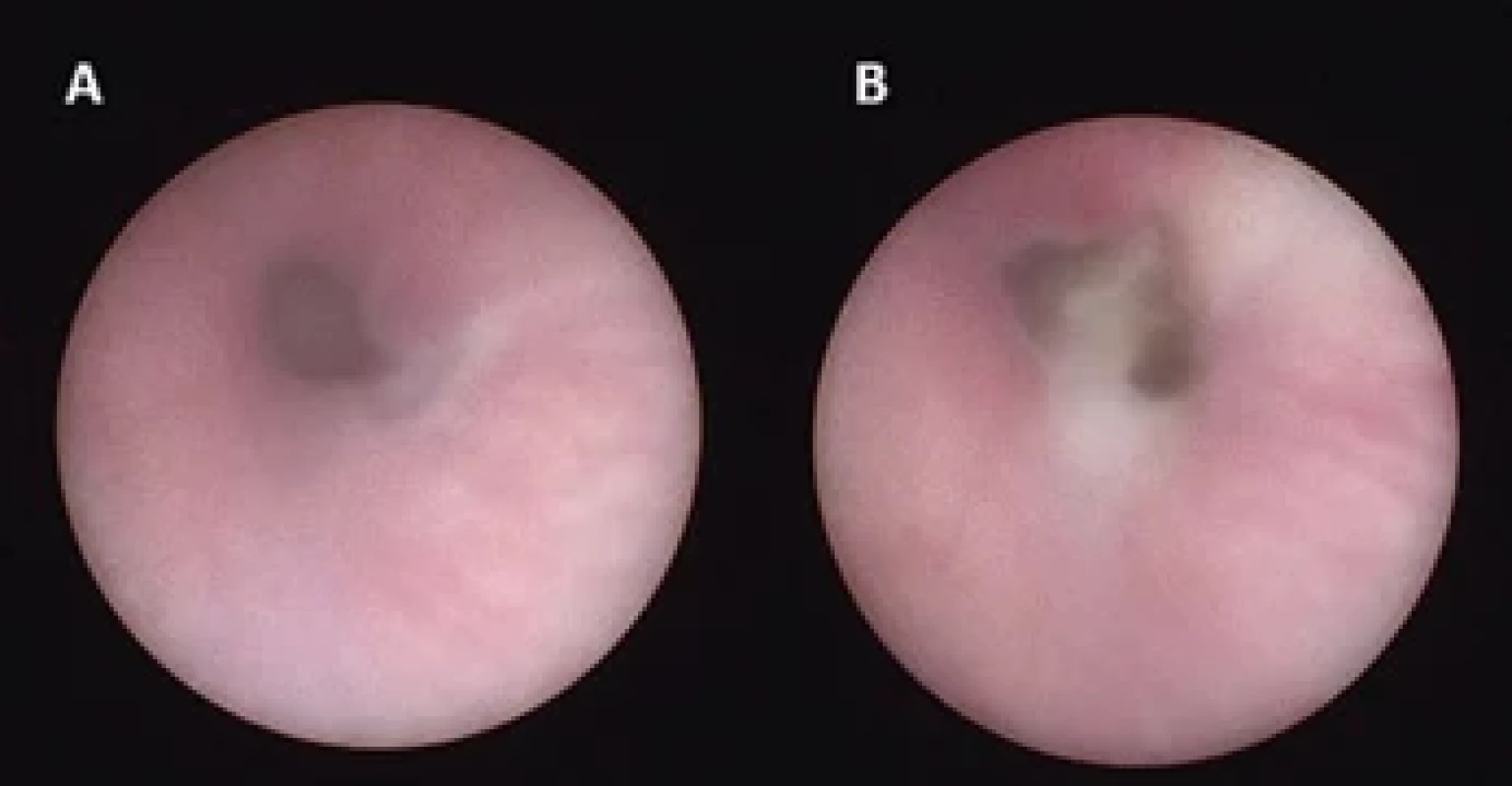 Endoscopic visualization of the fetal bladder.