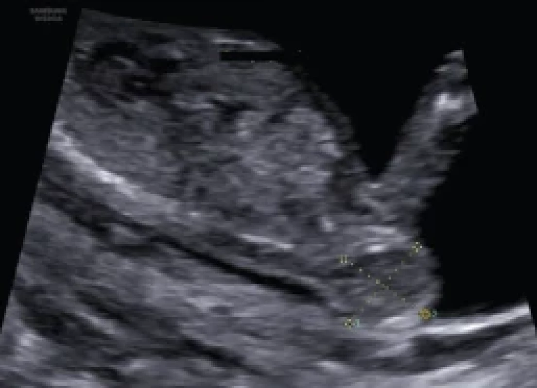 Sakrokokcygeální teratom, ultrazvukový nález ve 13. týdnu gestace. </br>Fig. 1. Sacrococcygeal teratoma, ultrasound fi nding at 13 weeks of gestation.