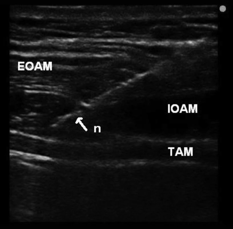 Ultrasonographic image for TAP block using in plane (IP)
technique