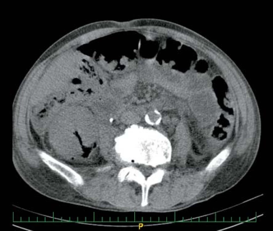 Ložisko plynu v pravé ledvině u muže středního věku
Fig. 2. Gas in right kidney in middle age man