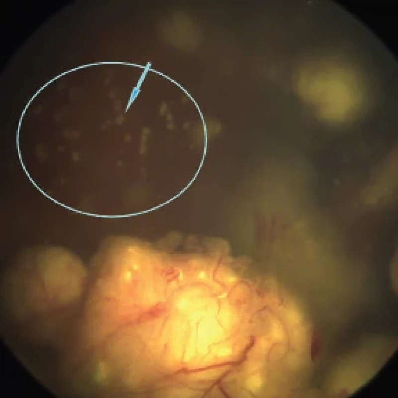 Classification of vitreous seeds: spheres