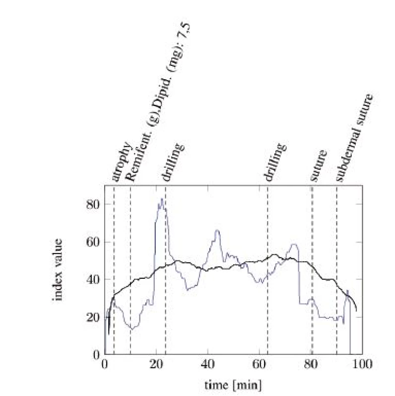 SAI baseline (blue) compared with ANI baseline (black) with particular painful events (tA13).