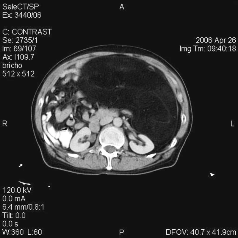 CT nález tumoru retroperitonea u pacientky č. 2
Fig. 2. A CT finding of the retroperitoneal tumor in the patient No. 2
