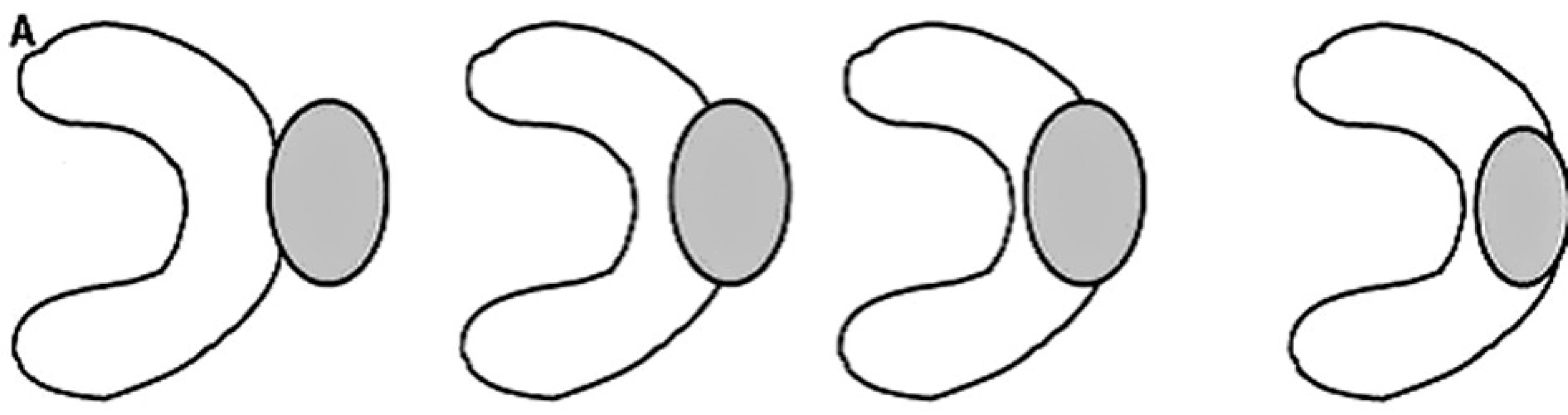 Schematické zobrazení vhodné lokalizace tumorů k perkutánní RFA
Fig. 1. Ascheme of tumor location suitable for percutaneous RFA