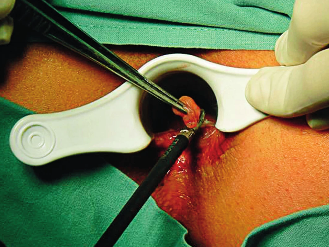 Hemoroidektomie UZ skalpelem (ultrasound scalpel hemorroidectomy)