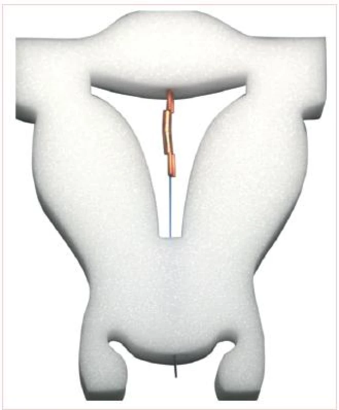 GyneFix 200 zaveden v modelu dělohy.